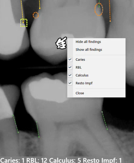A screenshot of a x-ray of teeth

Description automatically generated