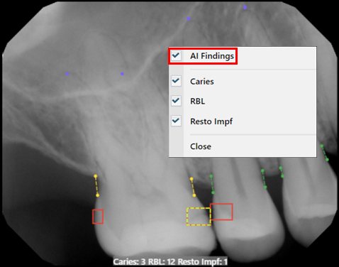 A x-ray of a human teeth

Description automatically generated