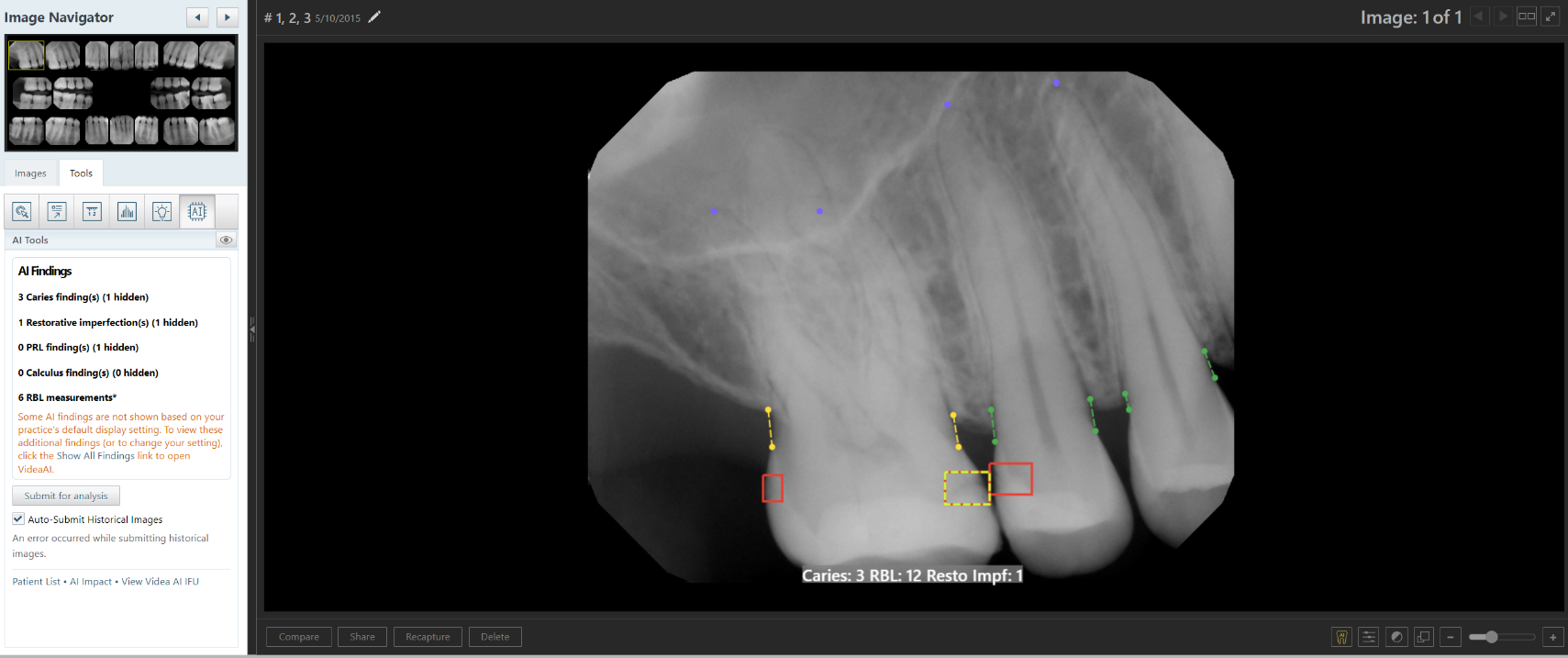 A x-ray of a tooth

Description automatically generated