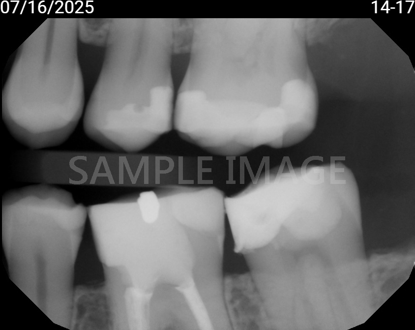 X-ray of teeth and dental implants
AI-generated content may be incorrect.